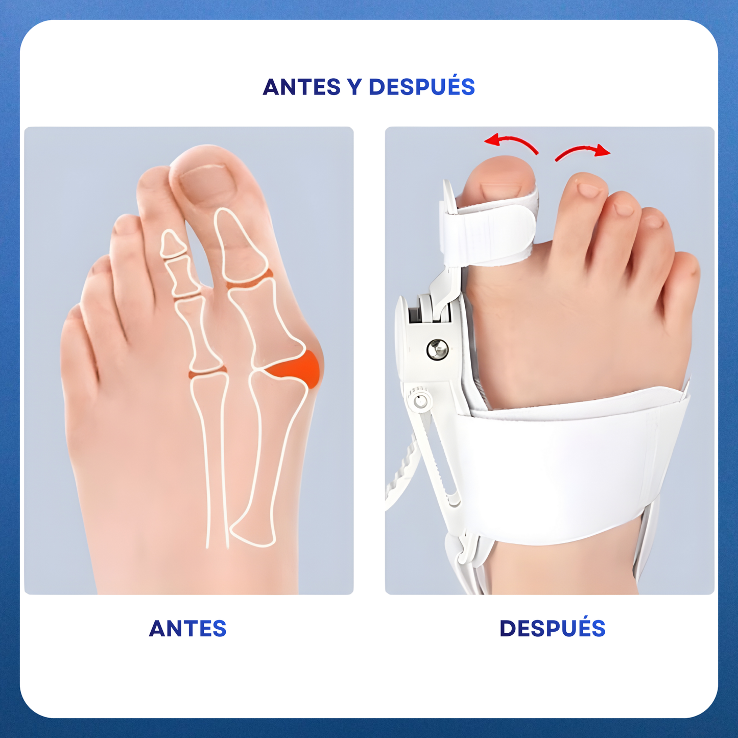 Comfylia™ ToeRelief Corrector